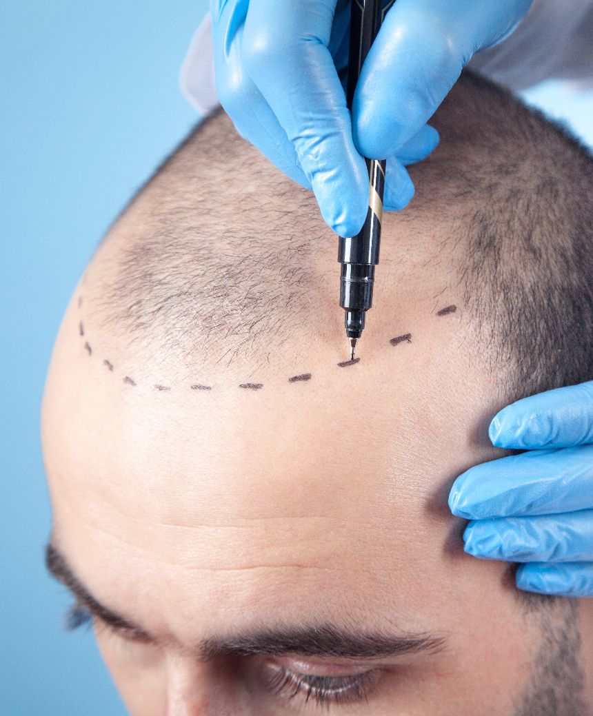 FUE Hair Transplant