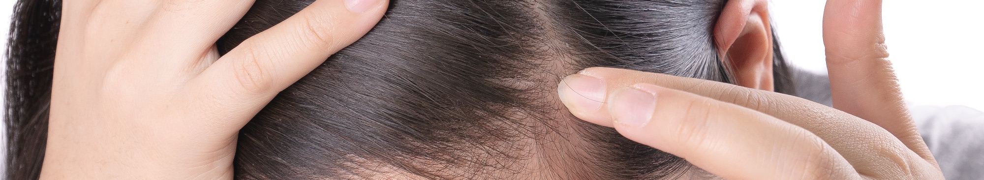 Female Hair Loss