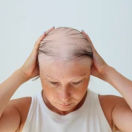 Female Baldness | Degree 3